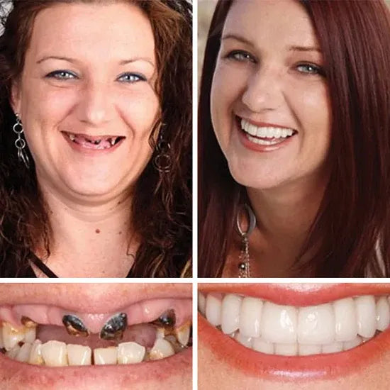 ⏰Ends Today: 70% OFF! 🌎Demorva™ Medical Full Denture with Strong Suctiond🦷Obtain American Dental Association (ADA) Certification