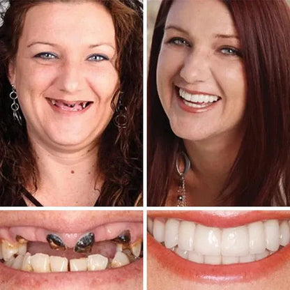 ⏰Ends Today: 70% OFF! 🌎Demorva™ Medical Full Denture with Strong Suctiond🦷Obtain American Dental Association (ADA) Certification