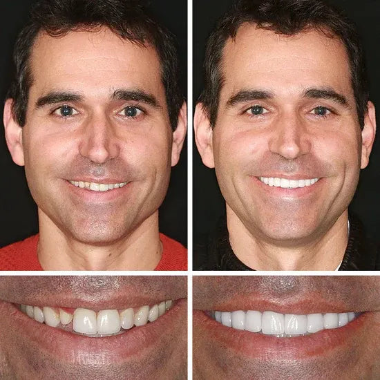 ⏰Ends Today: 70% OFF! 🌎Demorva™ Medical Full Denture with Strong Suctiond🦷Obtain American Dental Association (ADA) Certification