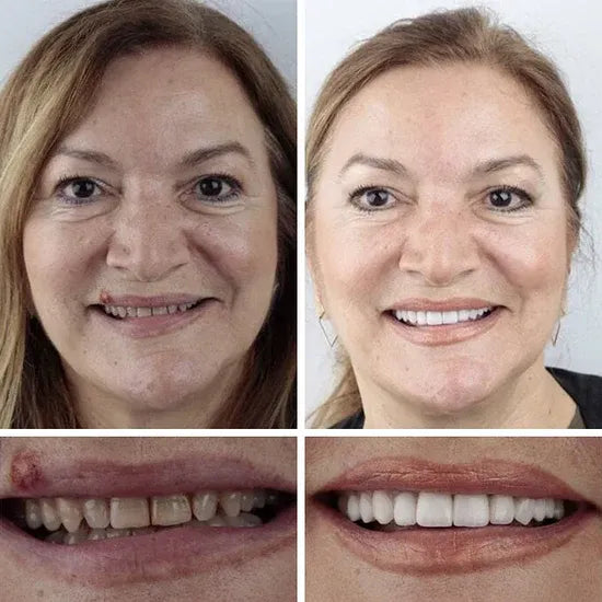 ⏰Ends Today: 70% OFF! 🌎Demorva™ Medical Full Denture with Strong Suctiond🦷Obtain American Dental Association (ADA) Certification